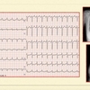 ECG-197：60才代女性。息切れと胸水貯留しての紹介でした。