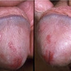 Penyakit Sipilis Di Malaysia 
