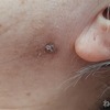 【親の介護】 #272 「これハサミで切って欲しい」ちょ、イボは簡単にハサミじゃ切れないって！ 