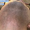 1回目の脱毛から一週間でひげに起きたこと