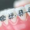 So sánh các loại mắc cài trong niềng răng thẩm mỹ