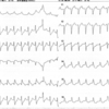 ECG-085：20才代女性。Hanging suicide。