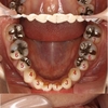 歯の先天的な欠損と不正咬合