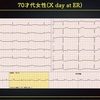 ECG-260：70才代女性。あまりにしんどくて、来院です。