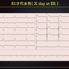 ECG-281：80才代女性。バタンと倒れてしまいました。