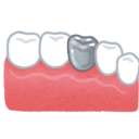 銀歯5本を白い歯オールセラミックに治した話