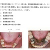 113回　歯冠補綴学振り返り　インプラント編