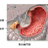 嘔吐の原因ーー幽門狭窄