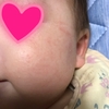 【乳児湿疹】顔にぶつぶつがたくさん…