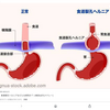 食堂裂孔ヘルニア