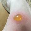 夏の虫刺され・かゆみの研究2025　（首、ノミ・ダニ、ブヨ）