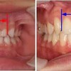 乳歯と永久歯の大きさの違い