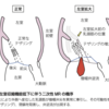 一次性MRと二次性MR、心房機能性MRの違い