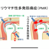 リュウマチ性多発筋痛症とは