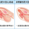 肥大型心筋症の診断基準と鑑別