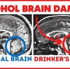 アメリカ　若い時期の過度の飲酒は、その後に永久的な脳損傷を起こします