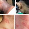 Obat Gatal Kulit Eczema atau Eksim