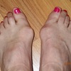 Over-Pronation Of The Foot What Are The Treatments