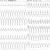 ECG-091：40才男性。深夜の突然の動悸で、ERに歩行来院。