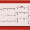 ECG-145:answer