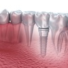 Cắm ghép implant – giải pháp phục hồi răng vĩnh viễn hiệu quả