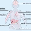 Spinal Muscular Atrophy Therapeutics Pipeline Analysis 2017 