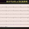 ECG-252：80才代女性。フラフラになりました。