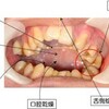 長期仰臥位の口腔の問題