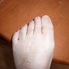 What Is Mortons Neuroma