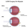 Advantages  As Well As Drawbacks Of Lasik  Surgical Treatment