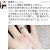 マジで怖い猫に噛まれてパスツレラ症になってしまった人の体験談