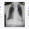 間質性肺炎を検出するAIを開発し、その有効性を検証した研究を論文化しました