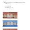 117回歯科医師国家試験【117C-36】歯冠補綴学：ラミネートベニヤの補修修復