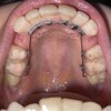 歯科矯正⑨調整2回目