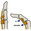 ド・ケルバン腱鞘炎〜スマホ腱鞘炎〜