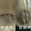 DFSP闘病生活回顧録（56）