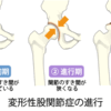 ５年前からの両股関節の痛み