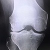高位脛骨骨切り術 -入院と手術と（その１）