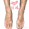 アトピー肌の症状改善写真 ⌲ 足＆背中編