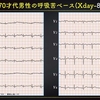 ECG-309：70才代男性の呼吸苦です。