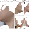 【40代が口コミ】脂肪溶解リニアハイフ(湘南美容)計6回の効果