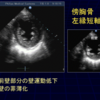 心エコー：菲薄化とエコー輝度上昇について