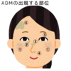 両頬に多発する灰色のシミ、ADMかも知れません