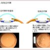 後発白内障の手術