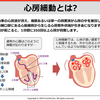 （イラスト）心房細動とは