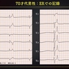 ECG-297：70才代男性。しんどかったです。