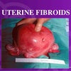 WHAT IS UTERINE FIBROIDS