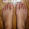 How To Fix Hammer Toes Without Surgery