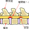 椎間板ﾍﾙﾆｱの治療