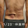 DFSP闘病生活回顧録（59）